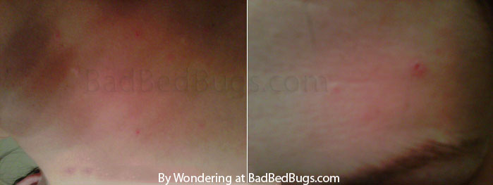 Bed Bug Marks